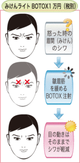 みけんボトックス.gif