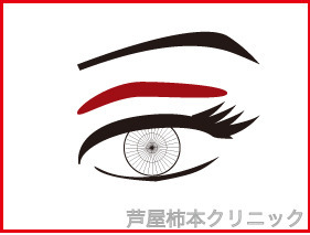 アイプチかぶれ.jpg