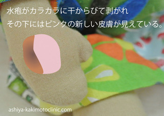 カサブタ取れる写真.jpg