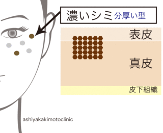 シミ取りレーザー
