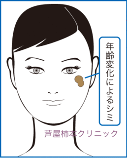 シミ位1.gif