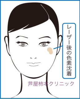 シミ位2.gif