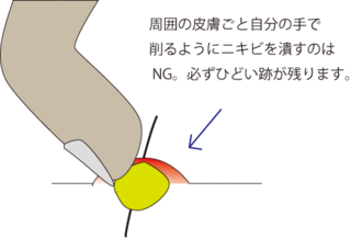 ニキビ潰し.gif