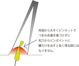 ニキビ潰し2.gif
