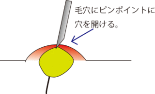 ニキビ潰し6.gif