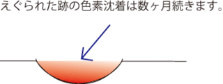 ニキビ潰し7.gif