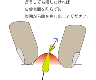 ニキビ潰し9.gif