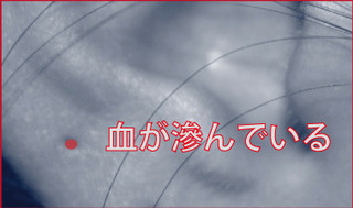 ピアス出血.jpg