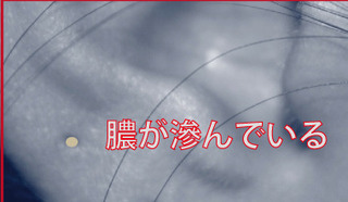 ピアス膿.jpg