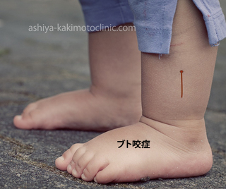ブト咬症.jpg