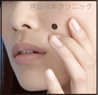 ホクロ大1.gif