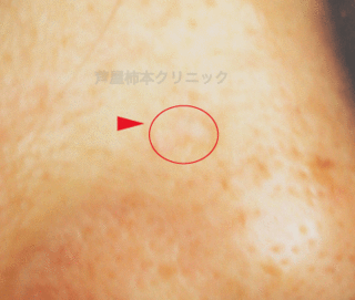 ホクロ手術10.gif