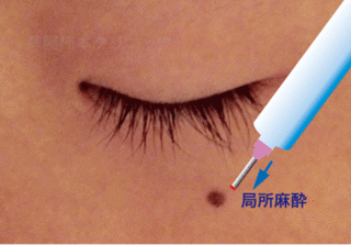 ホクロ手術2.gif
