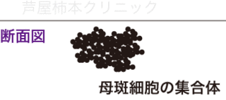 ホクロ手術3.gif