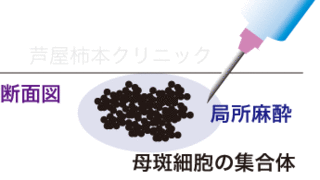 ホクロ手術4.gif