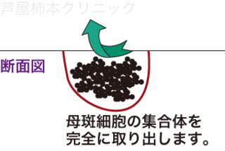 ホクロ手術5.gif