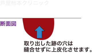 ホクロ手術6.gif