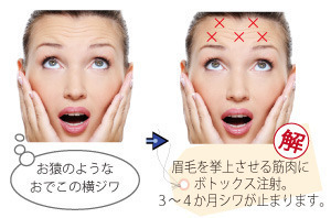 ボトックス