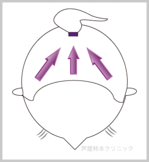 ポニーテール脱毛.gif