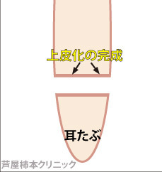 上皮化.jpg