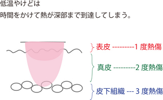 低温やけど.jpg
