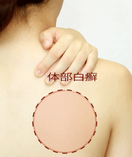 体部白癬.gif