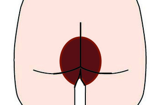 体部白癬.jpg