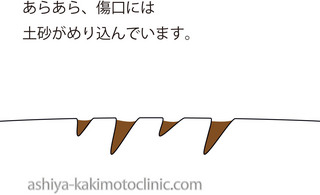 傷土砂入り.jpg