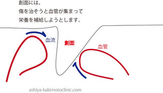 創面への血管増生.jpg