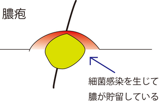 圧出2.jpg
