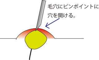 圧出5.jpg
