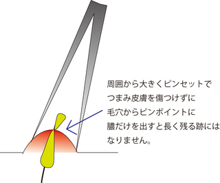圧出6.jpg