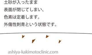 外傷性刺青.jpg
