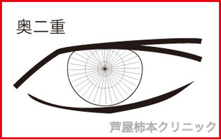 奥二重1.jpg