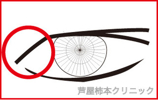 奥二重1−5.jpg