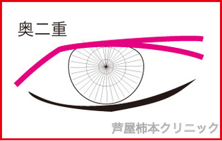 奥二重2.jpg