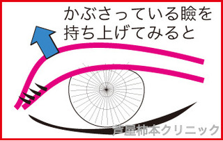 奥二重3.jpg