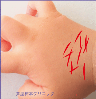 子供のあかぎれ手荒れ手の甲.gif