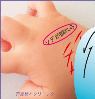 子供のあかぎれ手荒れ手の甲2.gif