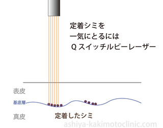 定着シミレーザー.jpg