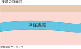 帯状疱疹1.jpg