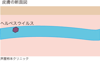 帯状疱疹2.jpg