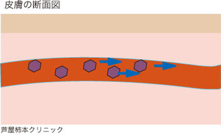 帯状疱疹4.jpg