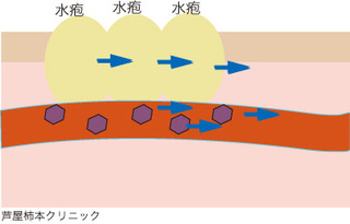 帯状疱疹5.jpg