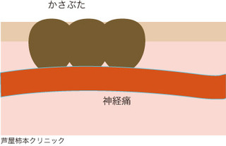 帯状疱疹6.jpg