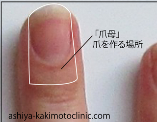 手足口病の爪3.jpg