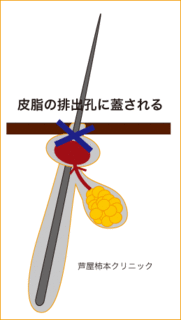 毛穴3「.gif