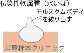 水いぼ2.jpg