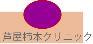水いぼ3.jpg