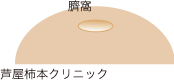 水いぼ3.gif
